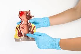 Cholecystectomy